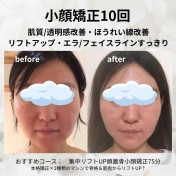 小顔矯正と肌質改善：顔の透明感とニキビに与える影響